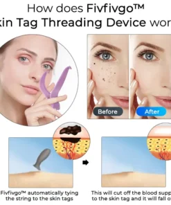 Fivfivgo™ Skin Tag Threading Device